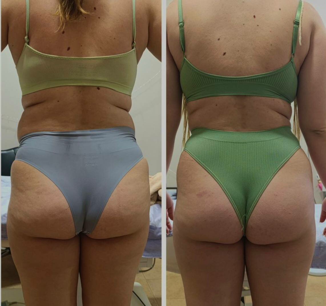 антицеллюлитный массаж до и после 10 сеансов, до и после антицеллюлитного массажа, антицеллюлитный массаж до и после, целлюлит, липосакция бедер