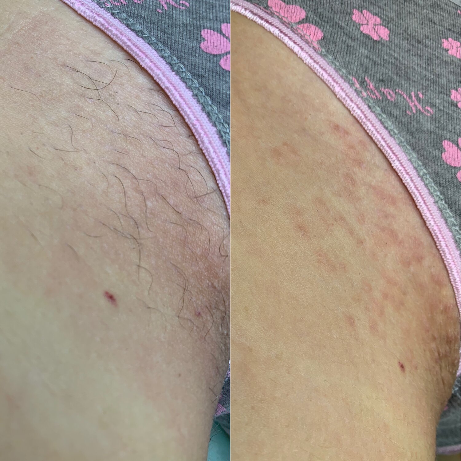 часть тела человека, эпиляция, депиляция, электроэпиляция, фотоэпиляция