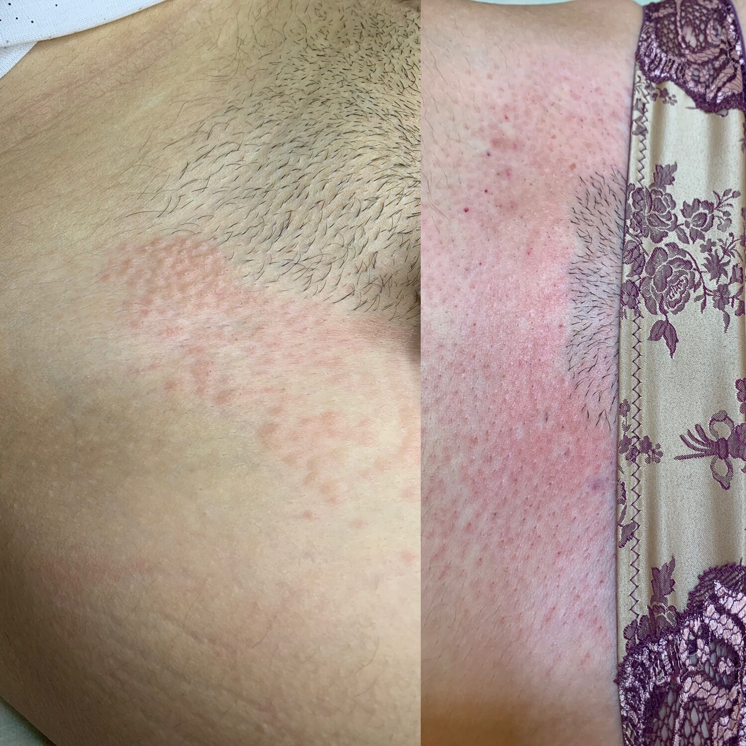 электроэпиляция, фотоэпиляция, часть тела человека, лазерная эпиляция, эпиляция