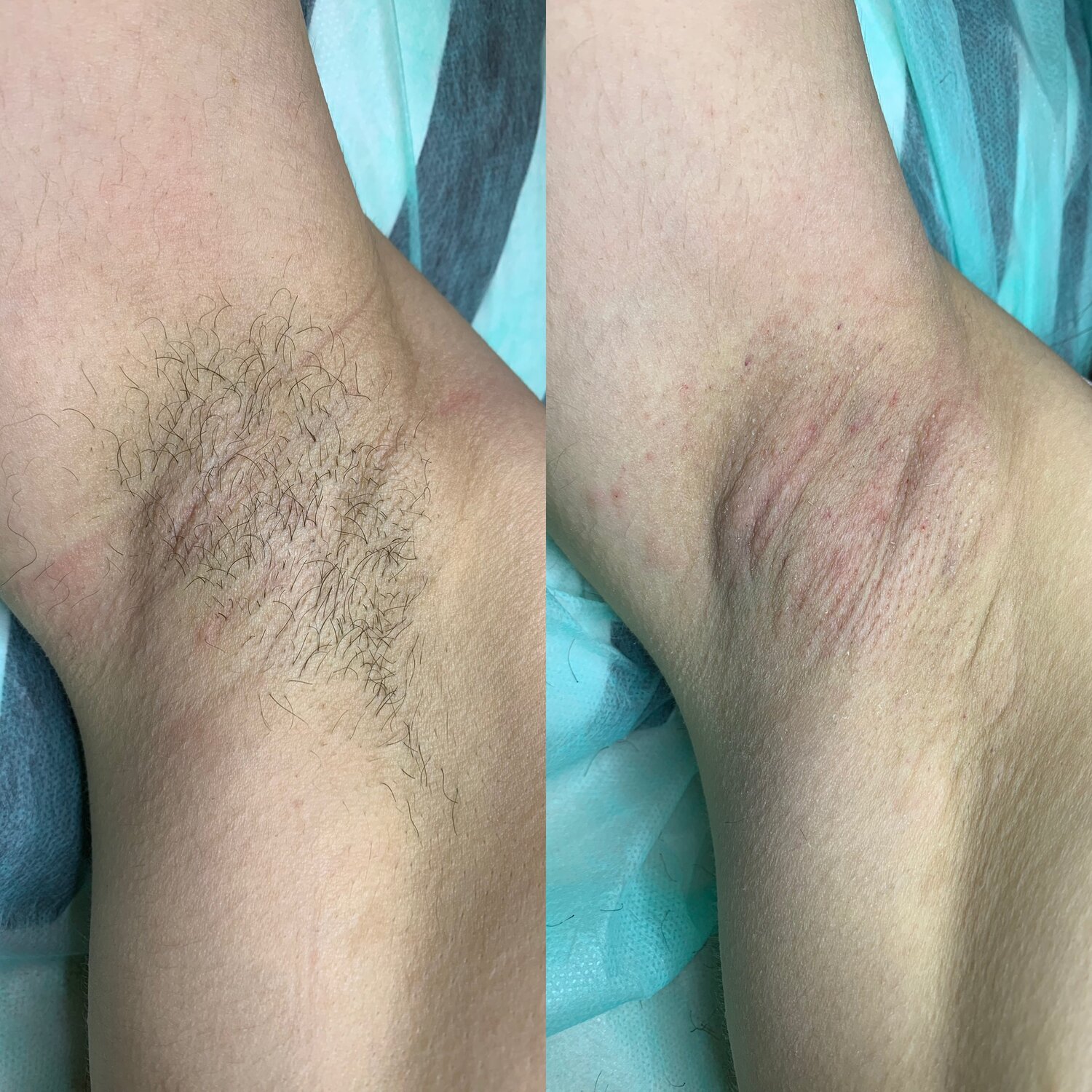 эпиляция, депиляция, фотоэпиляция, лазерная эпиляция, шугаринг подмышек