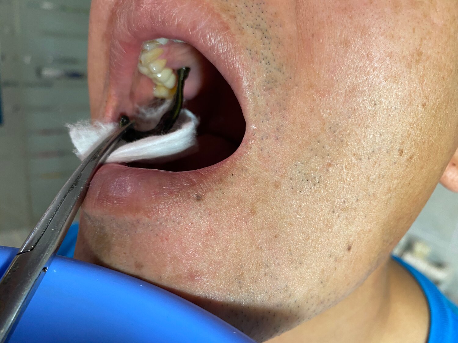 зубы, следы на коже, выдернутый зуб, преобразование зубов