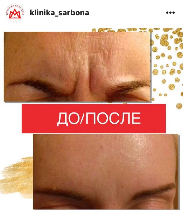 Ботокс в лоб