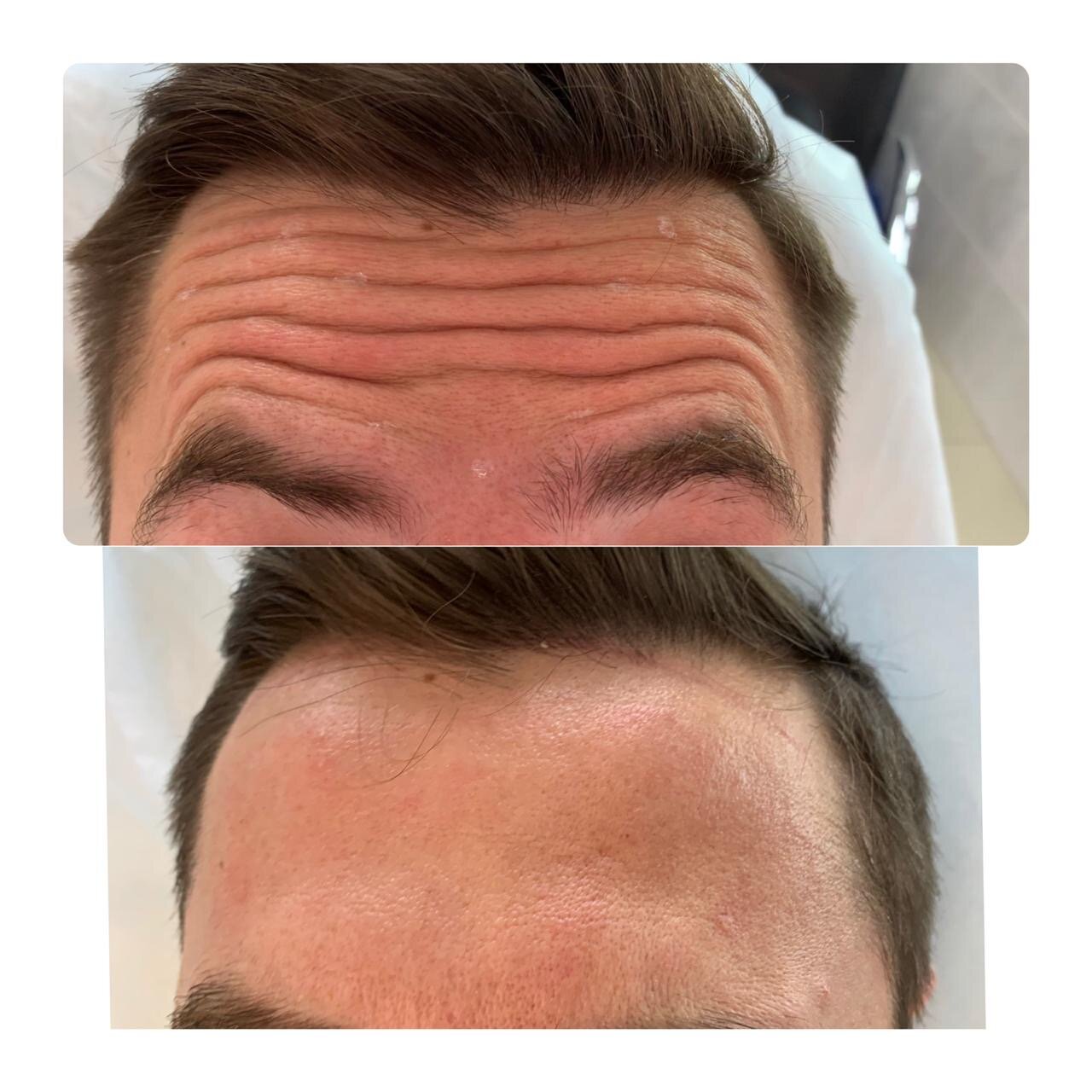 лица, часть лица, морщины, ваше лицо, ботулинотерапия для мужчин