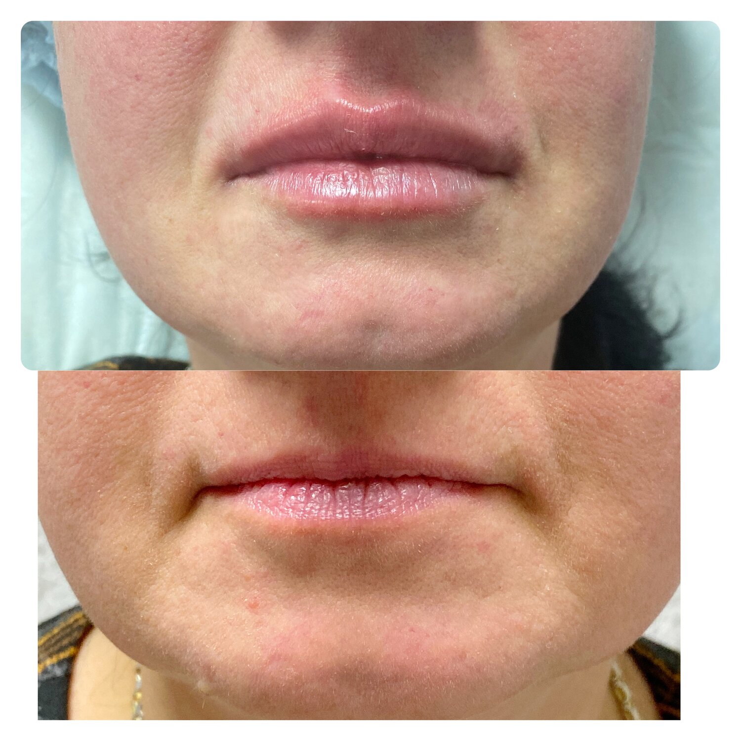 коррекция губ и носогубных складок, контурная пластика уголков губ, ювидерм носогубка, коррекция асимметрии губ филлером, опущенные уголки губ