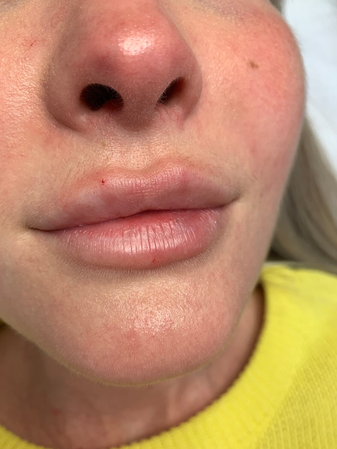 часть лица, герпес около носогубных складок, лица, губа, отек