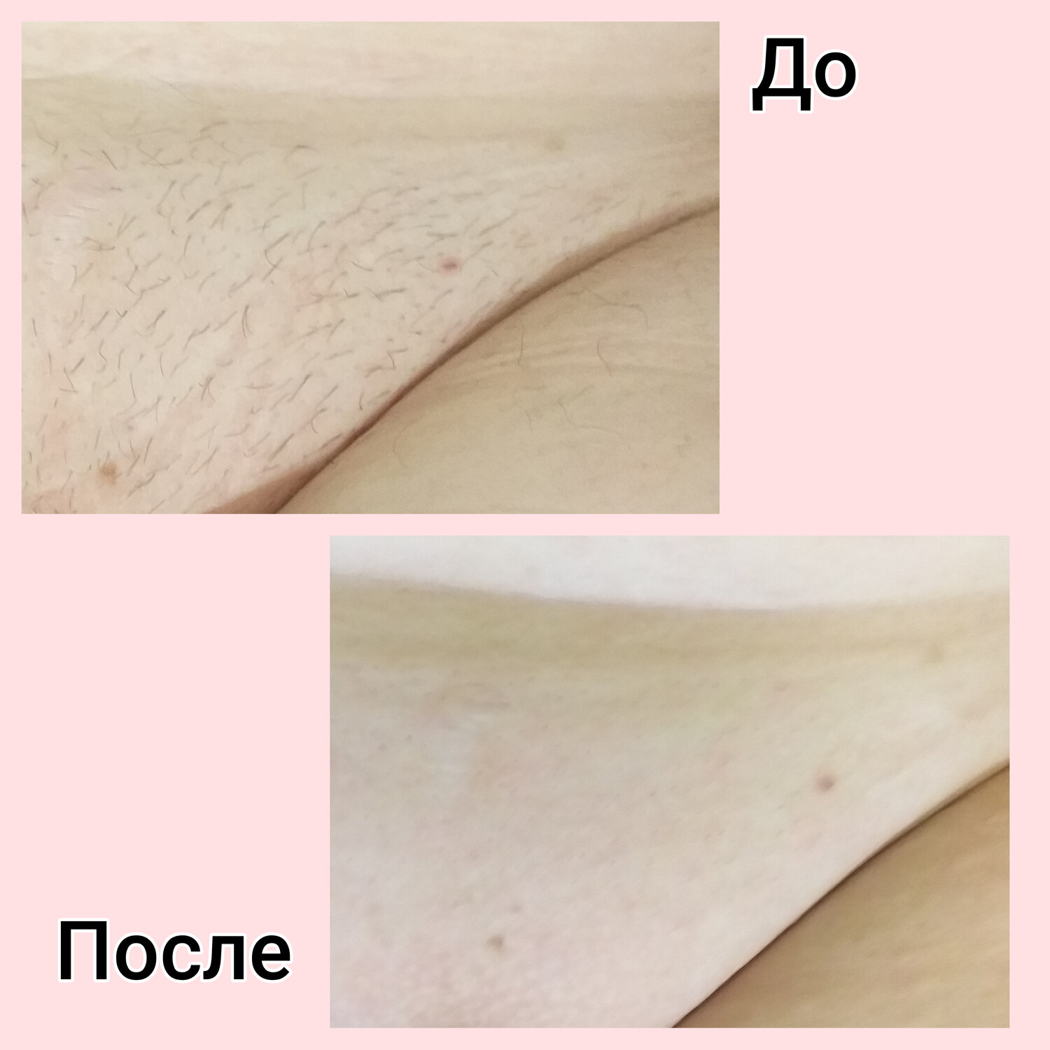 эпиляция, шугаринг, лазерная эпиляция, депиляция, часть тела человека