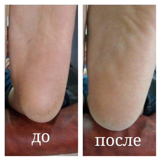 Аппаратный педикюр