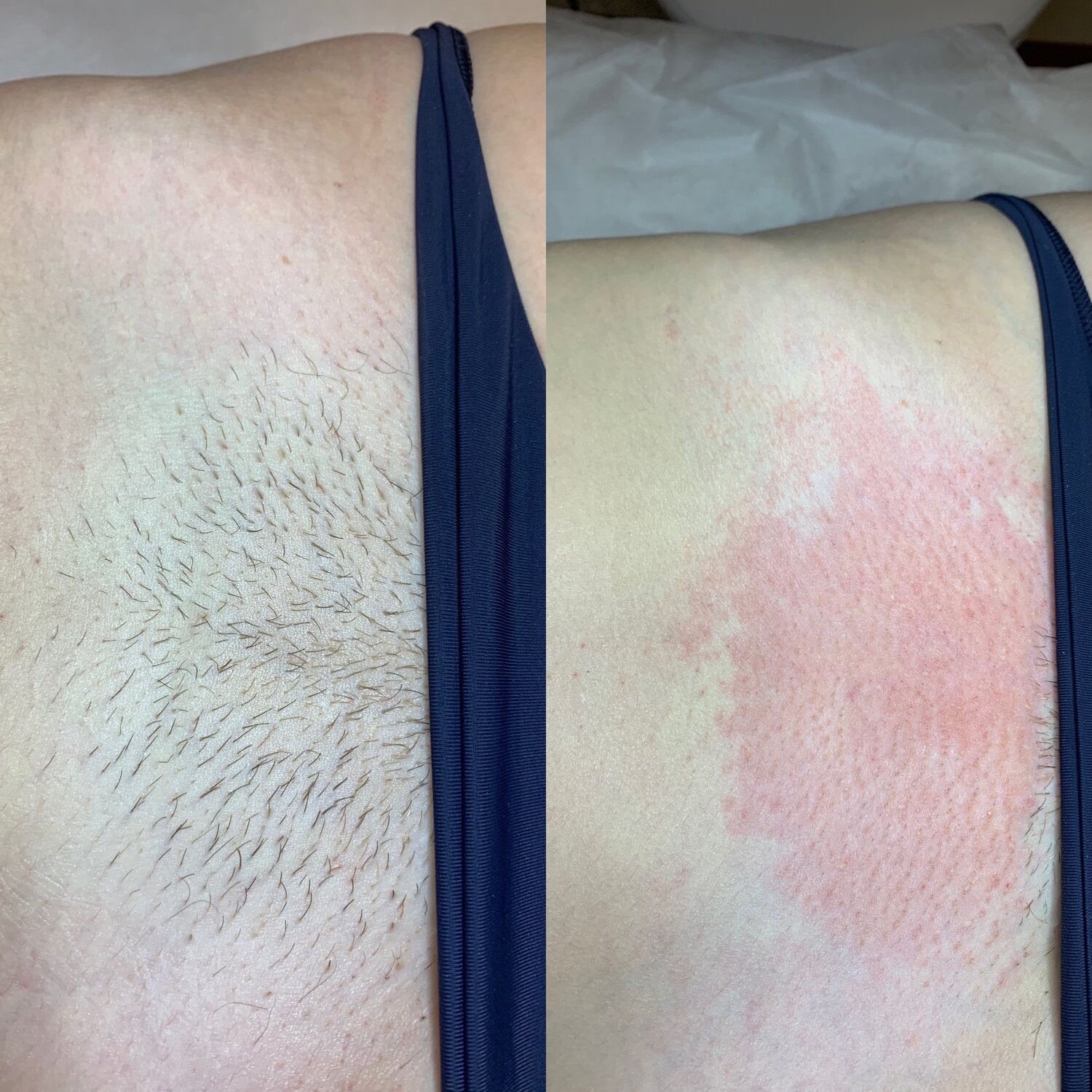 электроэпиляция, лазерная эпиляция, фотоэпиляция, часть тела человека, депиляция