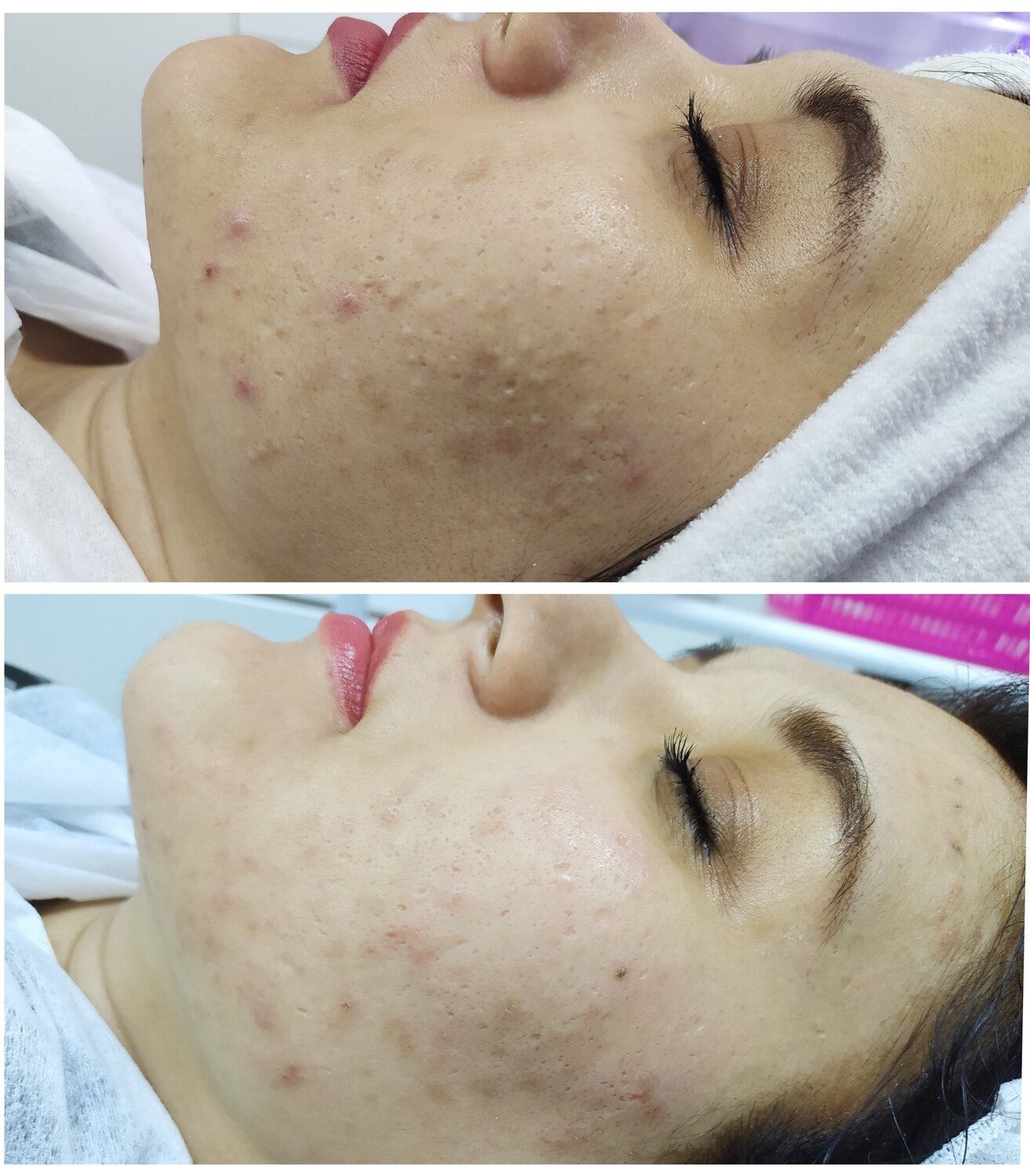 пилинг, пилинг для лица prx-t33, acne stop пилинг, пилинг prx-t33, пилинг prx до и после