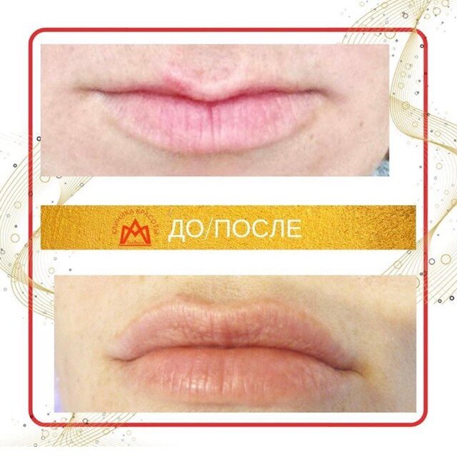 Филлеры с гиалуроновой кислотой