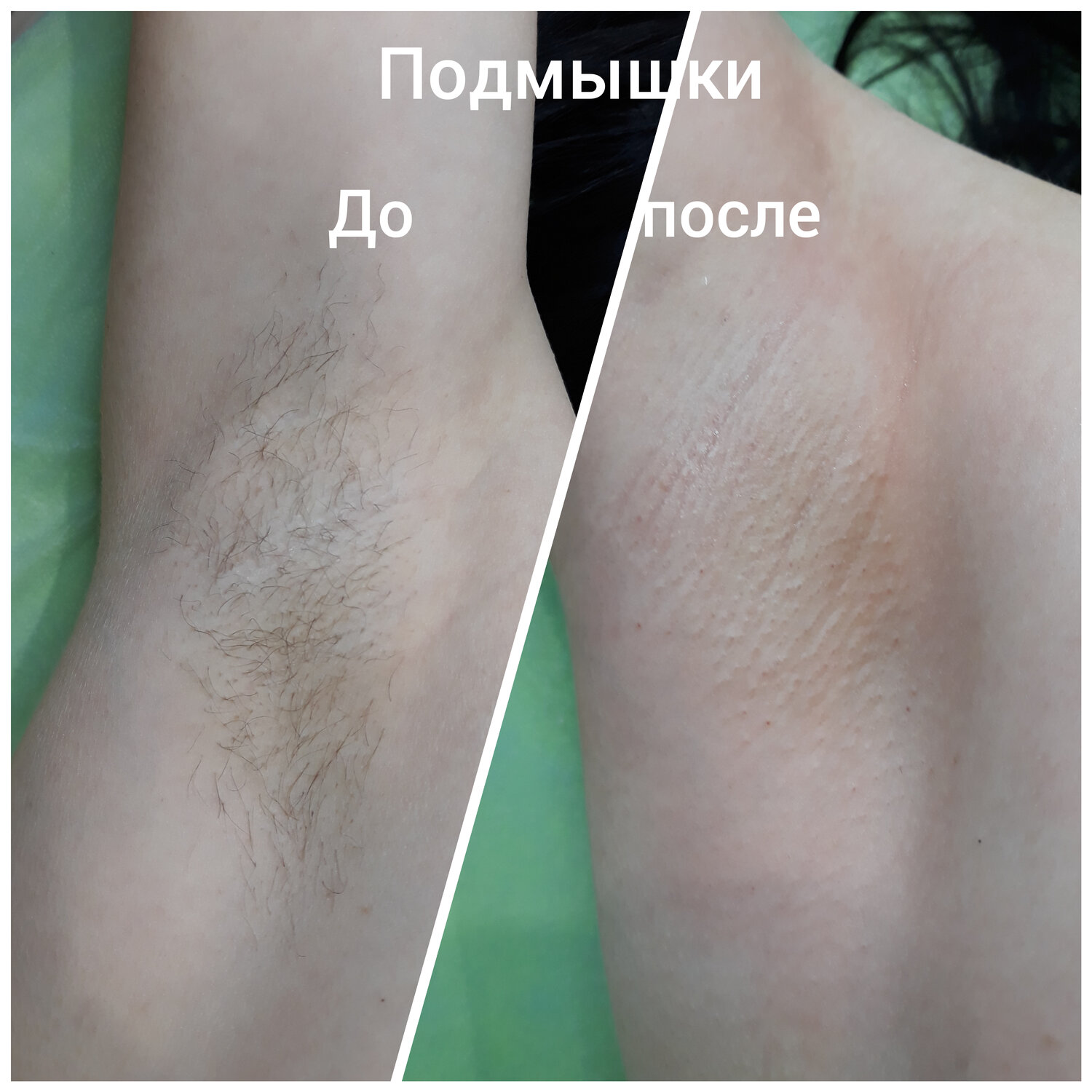 депиляция подмышки до после, спа шугаринг подмышек, эпиляция, фотоэпилятор до и после, депиляция