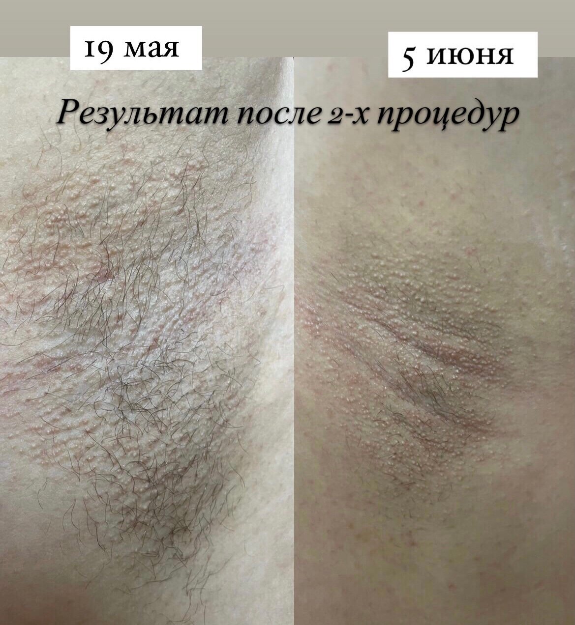 электроэпиляция, депиляция бикини до и после, эпиляция, электроэпиляция в красногорске, электроэпиляция бикини