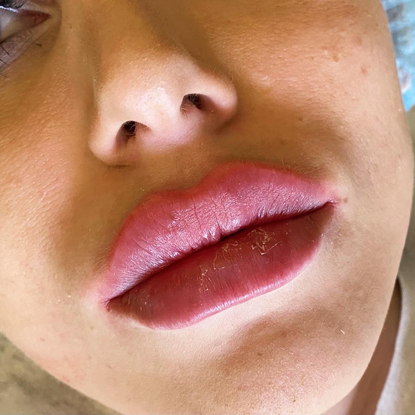 часть лица, губа, лица, lip, увеличение губ 2 мл
