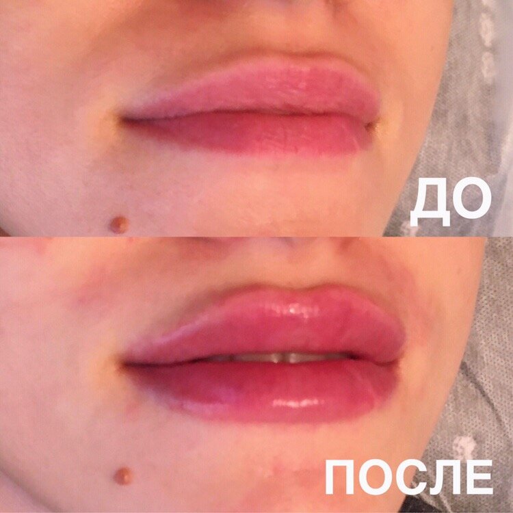 губы с гиалуроновой кислотой 1 мл, гиалуроновая кислота, губы 0.7 мл, цвета тинель губы перманентный макияж, губа