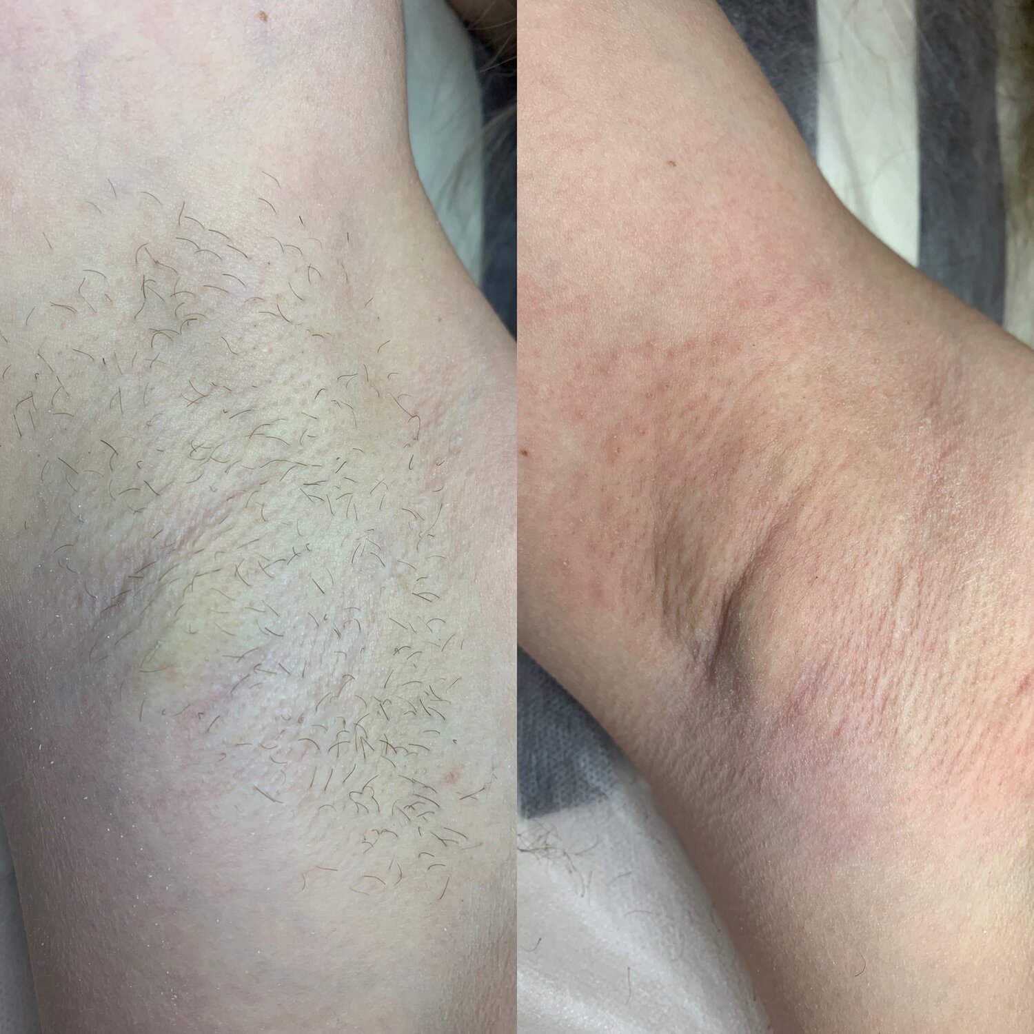 эпиляция, депиляция, фотоэпиляция, шугаринг, электроэпиляция