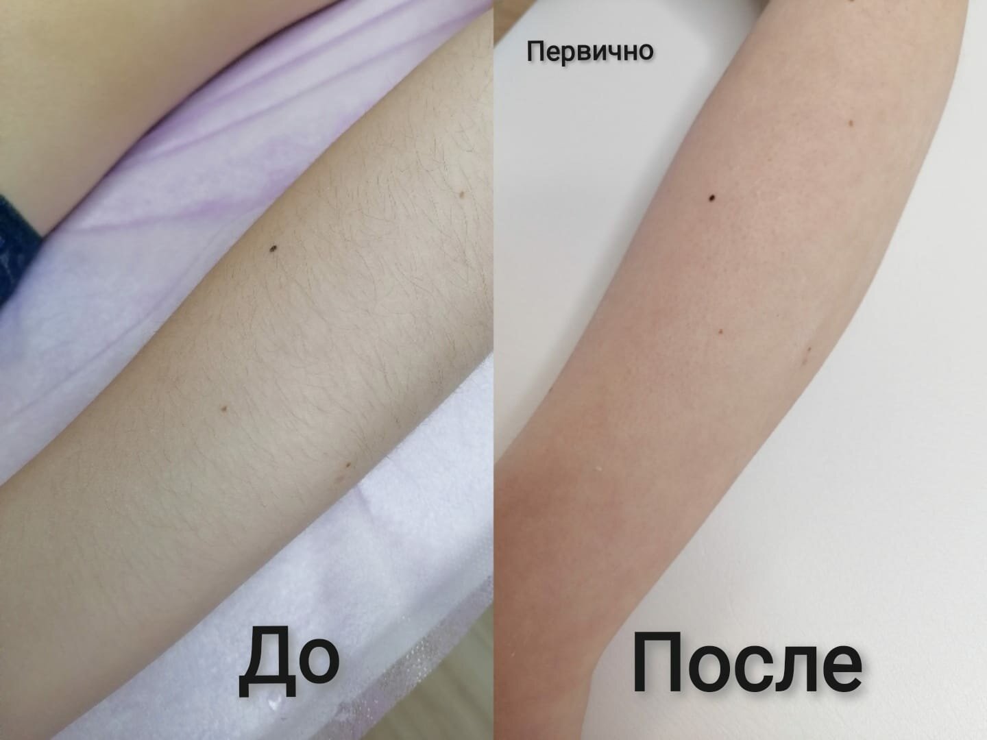 восковая депиляция, депиляция, депиляция воском, шугаринг, депиляция шугаринг