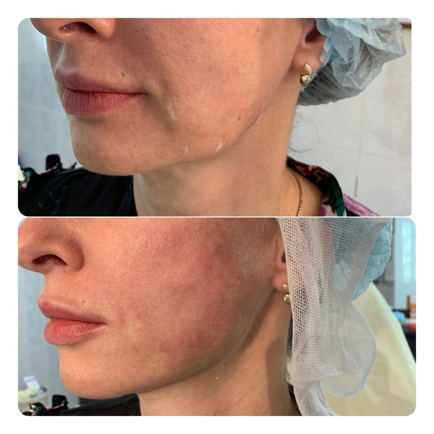 нити когги, контурная пластика подбородка, биоармирование aptos (нитевой лифтинг), нити, контурная пластика углов нижней челюсти