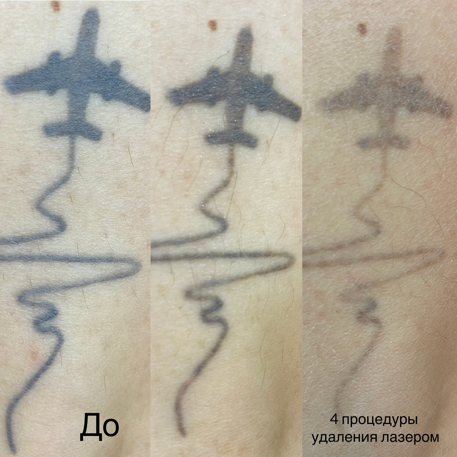 удаление татуировок лазером, тату самолет, тату, удаление тату лазером, сведение тату