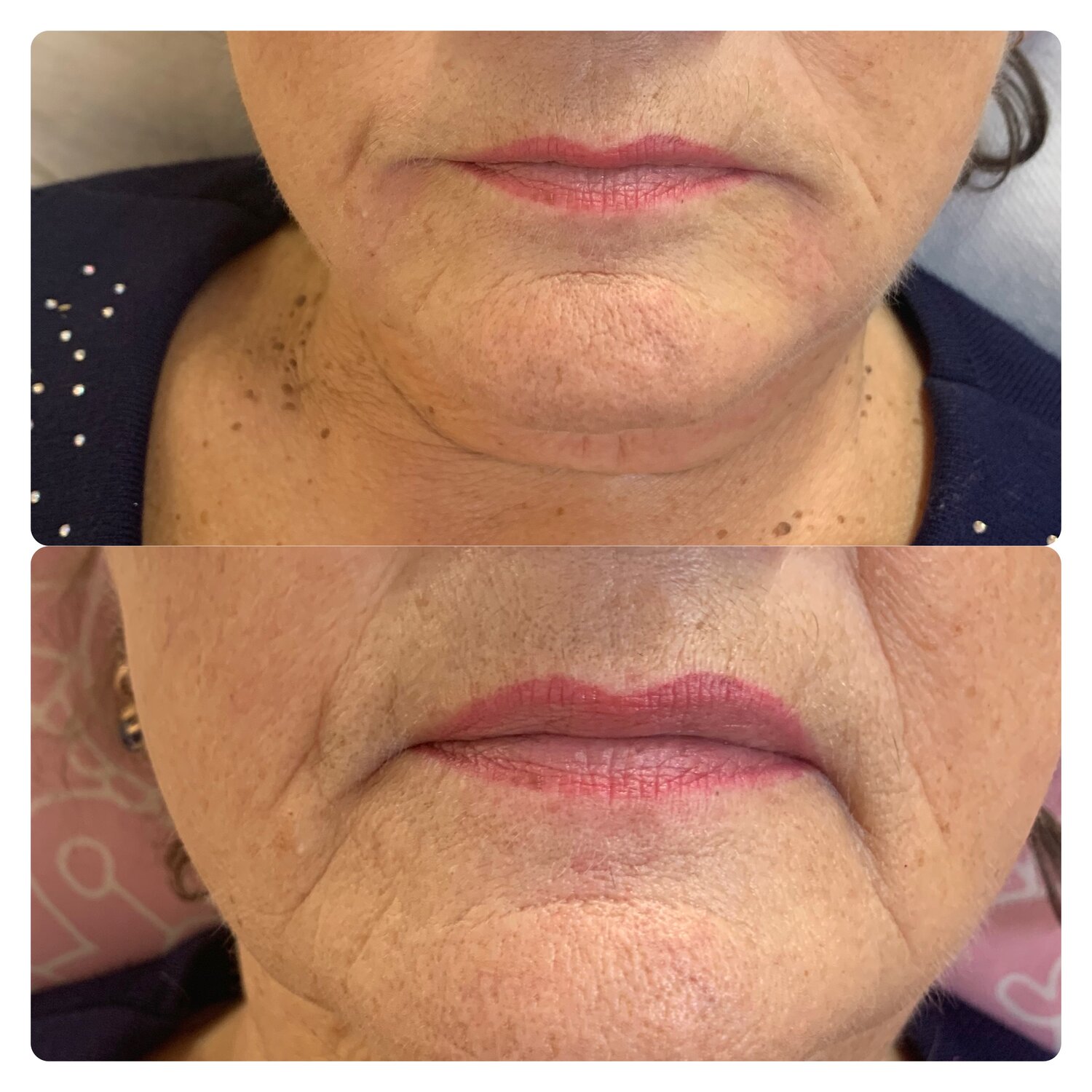 асимметрия уголков губ, губоподбородочные морщины, часть лица, лица, омоложение