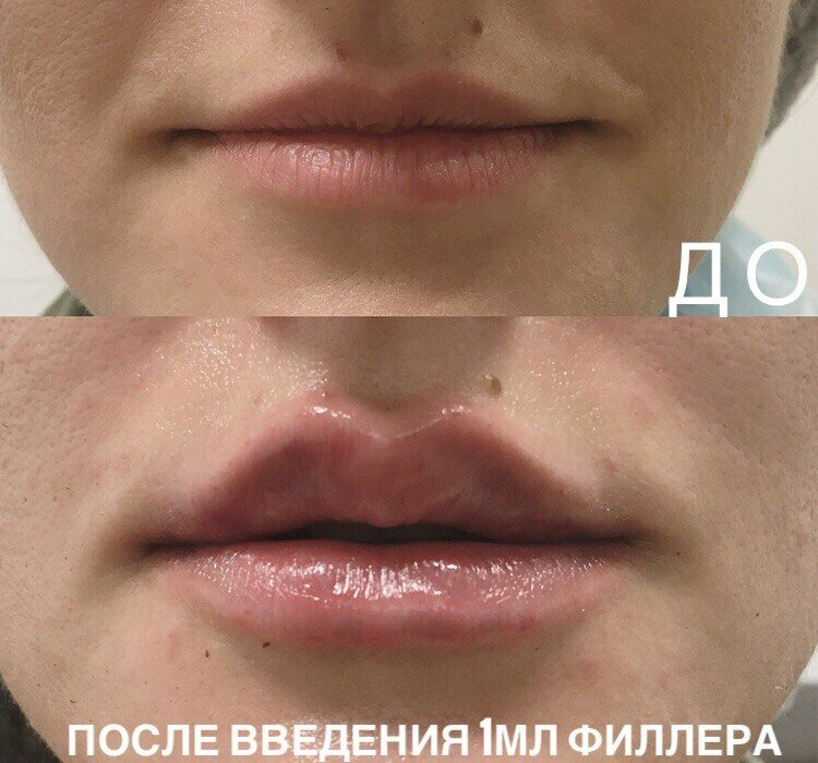 увеличение губ асимметрия, увеличение губ, увеличение губ чебоксары, гиалуроновая кислота, девушки после коррекции губ