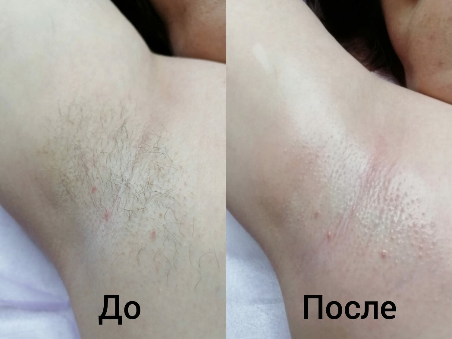 восковая депиляция, восковая эпиляция, электроэпиляция, эпиляция депиляция, лазерная эпиляция