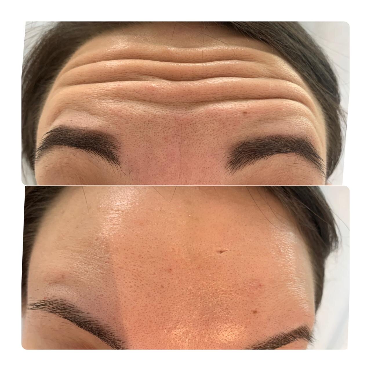 лица, бровь, морщины, косметология, beautician