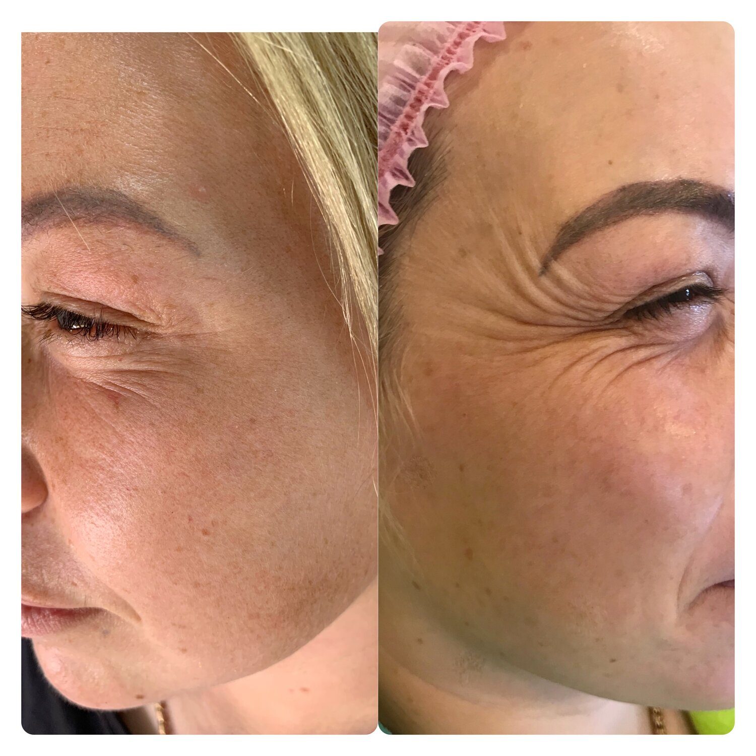 тредтерапия мезонитями, лица, мезотерапия лоб, мезотерапия, пилинг