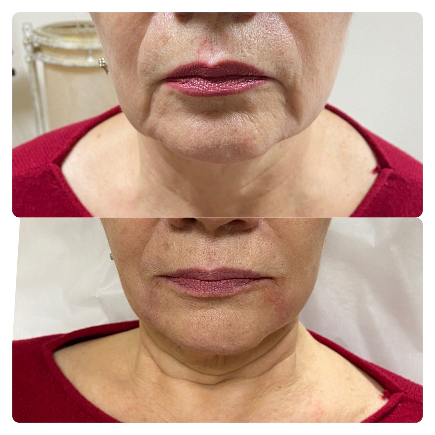 губоподбородочные морщины, асимметрия уголков губ, морщины, лица, часть лица