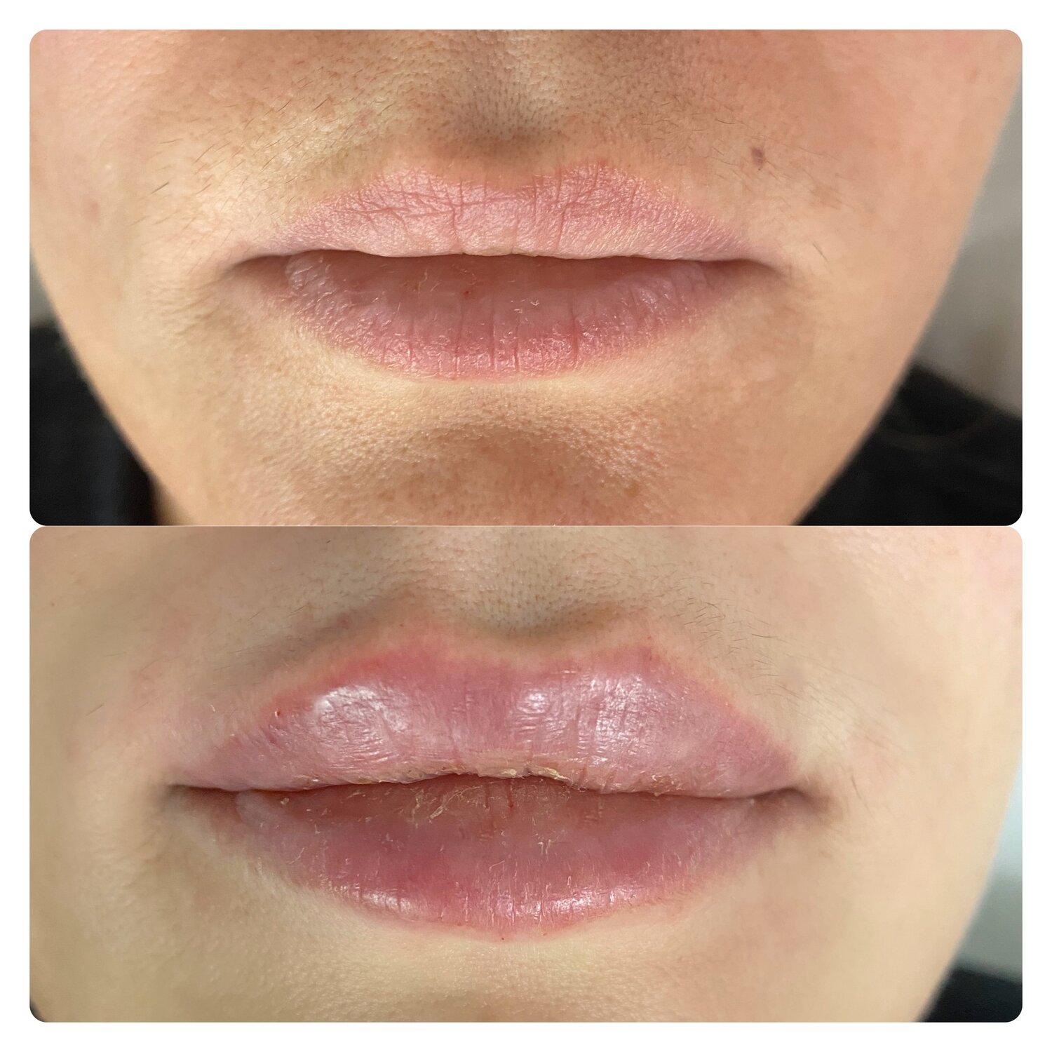 мезотерапия губ, пм губ с растушевкой, моделирование губ, коррекция формы губ, губа