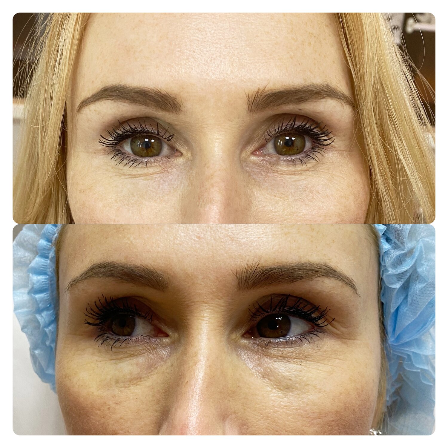 гиперкоррекция носослезной борозды, мешки под глазами эстетика, блефаропластика, лица, гришкян липофилинг