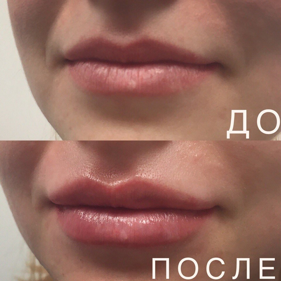 схема увеличения губ гиалуроновой кислотой, гиалуроновая кислота, эффект увлажненных губ, нанонапыление губ, пластика губ в краснодаре