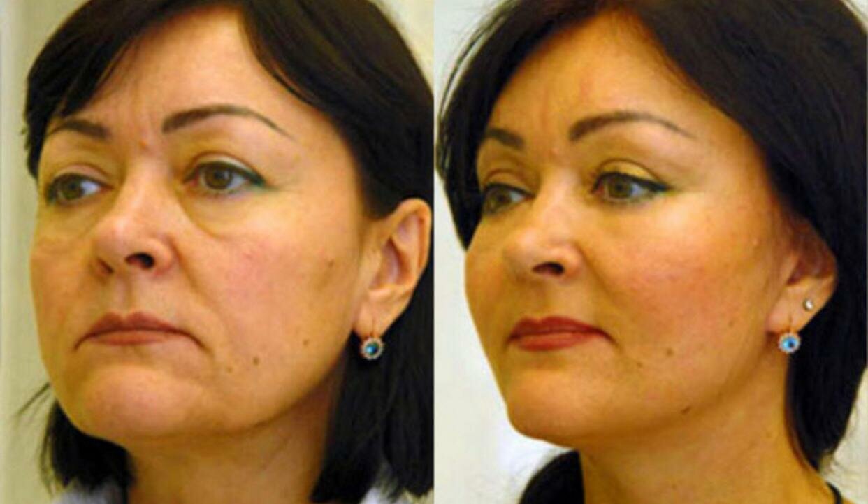 подтяжка лица, эндоскопическая подтяжка лица, смас подтяжка нити, эндоскопическая подтяжка средней зоны лица, эндоскопический лифтинг средней зоны лица