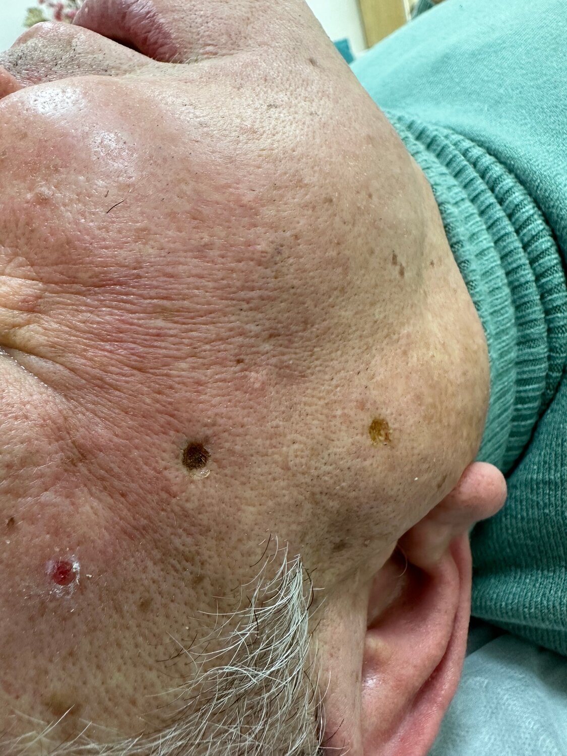 кератома кожи, кератома, невус, меланома кожи, себорейные кератомы