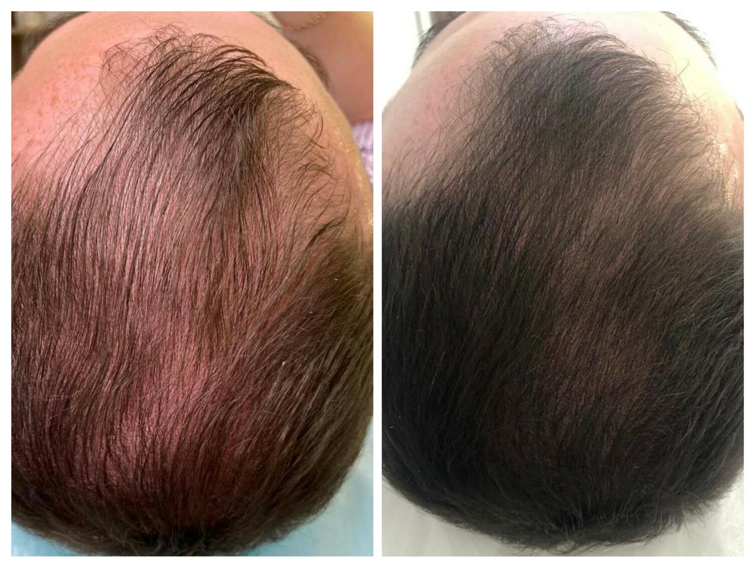 мезотерапия волосистой части головы, пилинг кожи головы, волосистая часть головы, плазмолифтинг кожи головы, плазмолифтинг для волос