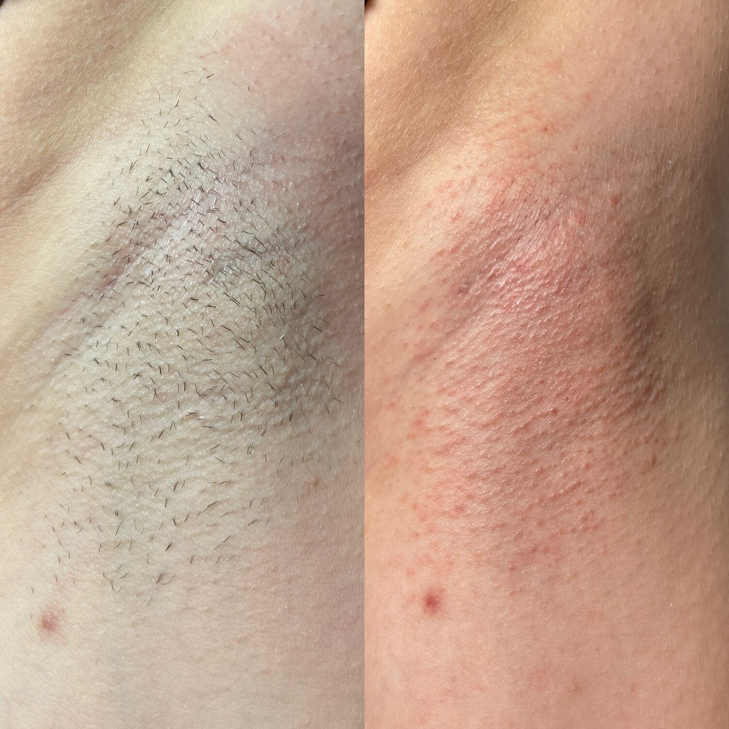 электроэпиляция, лазерная эпиляция, эпиляция, депиляция, электроэпиляция подмышек