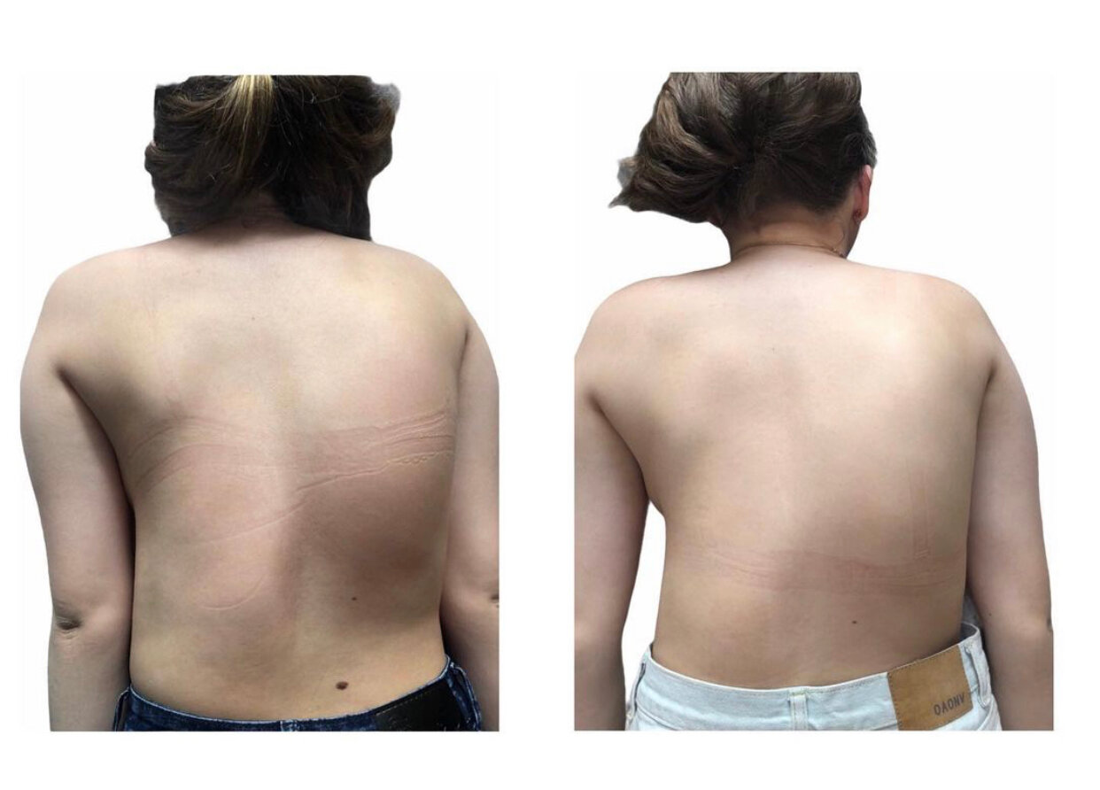 сколиоз, сколиоз реберный горб, сколиоз 4-й степени, ротация осанки, степени сколиоза