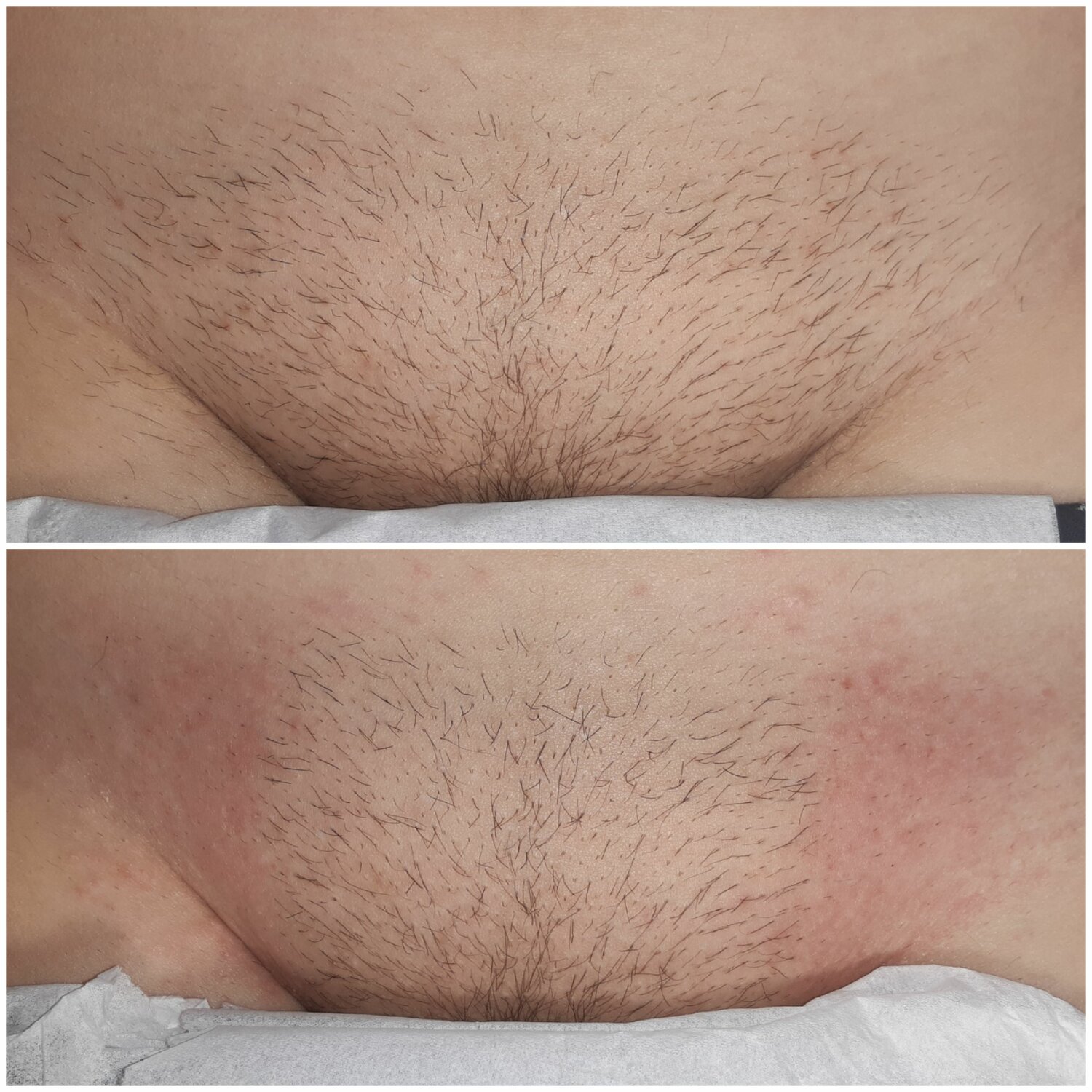 эпиляция глубокого бикини, глубокое бикини, глубокое бикини депиляция, шугаринг классическое бикини, зона бикини