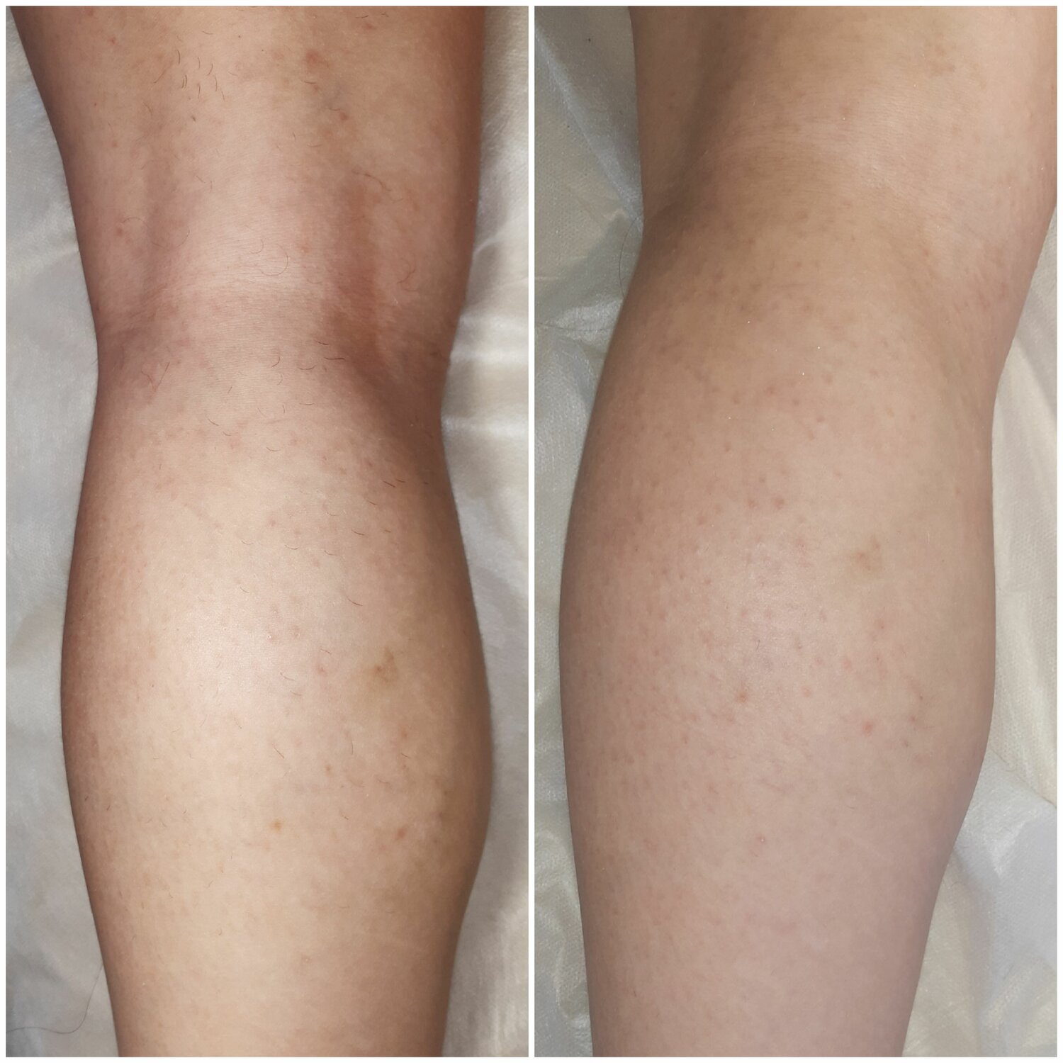 шугаринг депиляция, шугаринг, депиляция, шугаринг ног, эпиляция