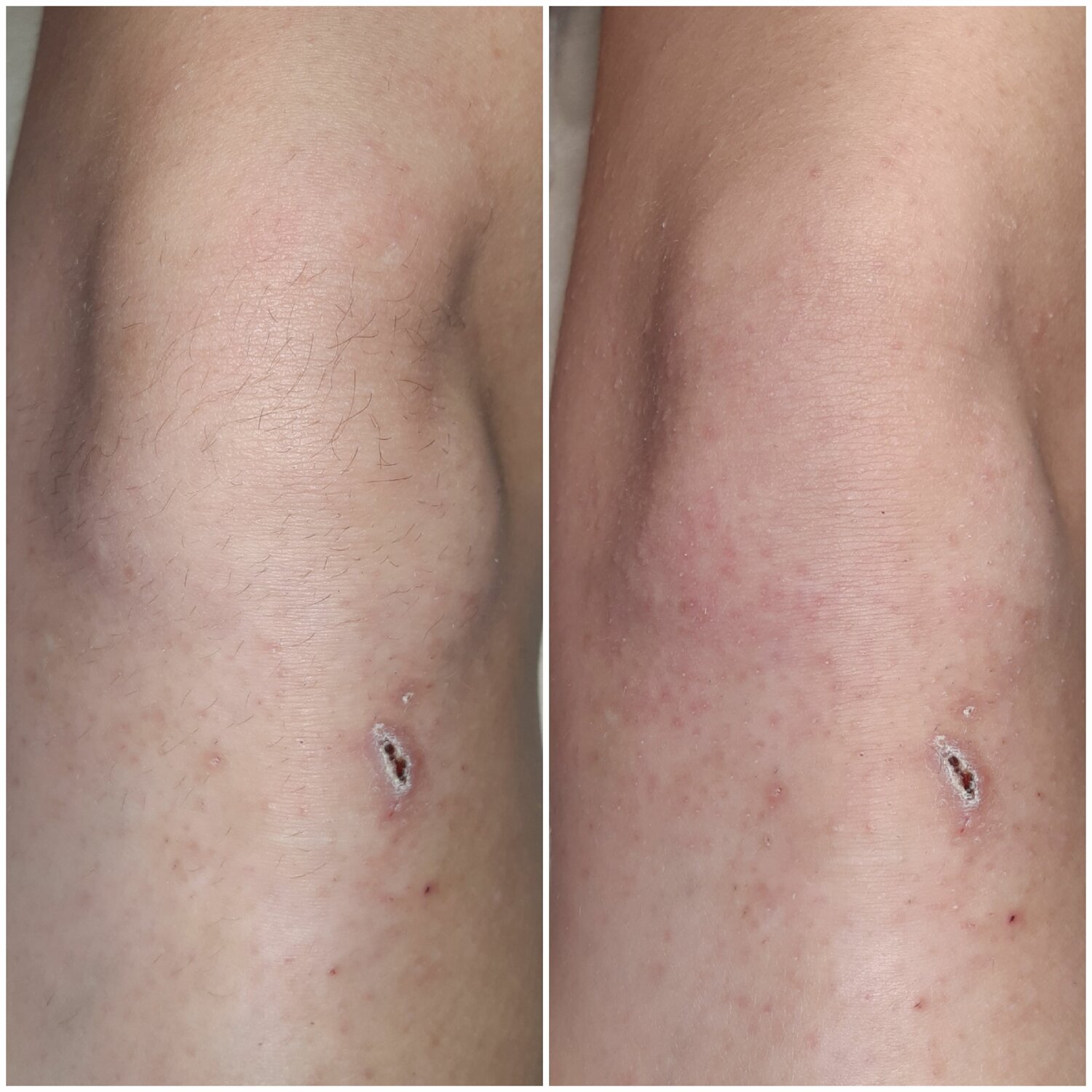 часть тела человека, варикоз на ногах, варикоз вен начальная стадия, варикоз на ноге у мужчин операция, склеротерапия вен