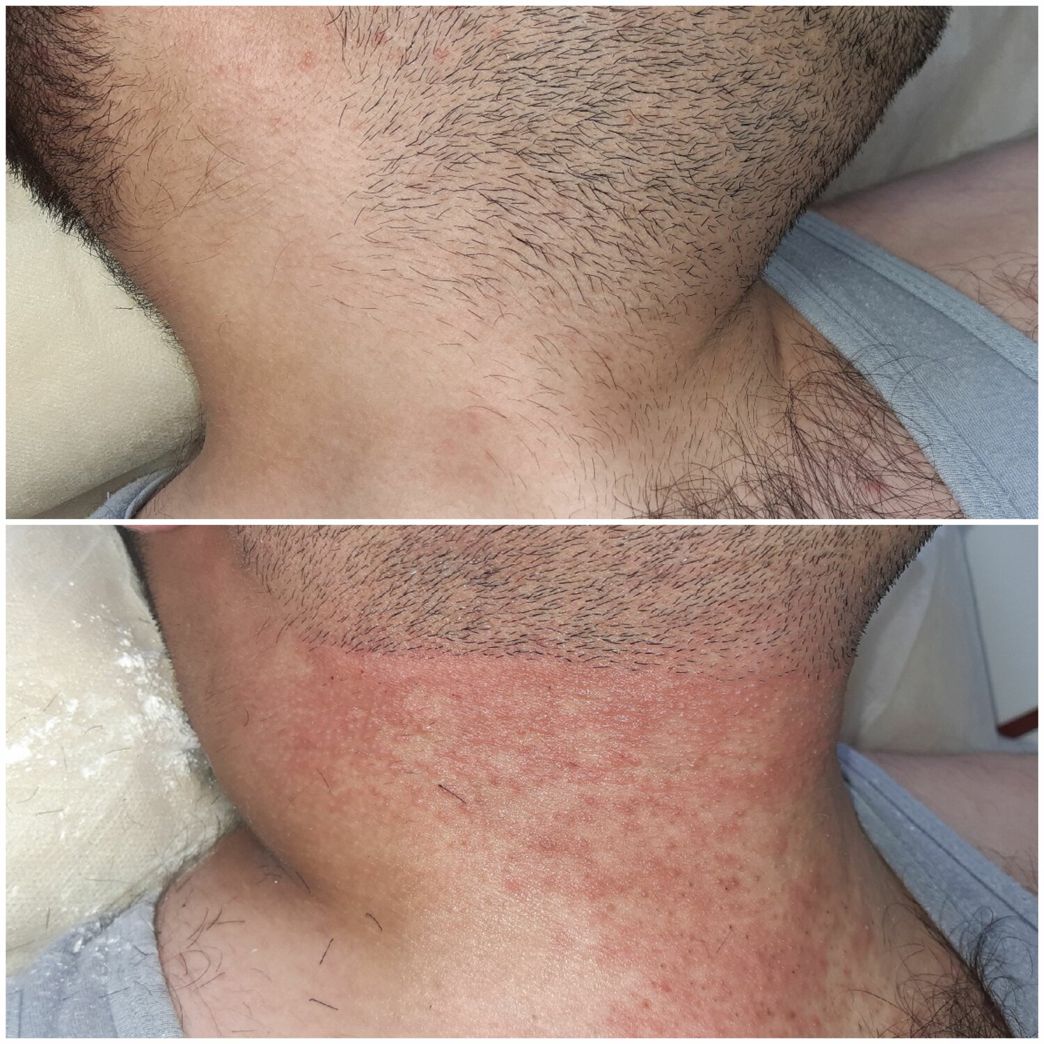 лазерная эпиляция лица для мужчин, лазерная эпиляция лица, лазерная эпиляция, мужская лазерная эпиляция, электроэпиляция