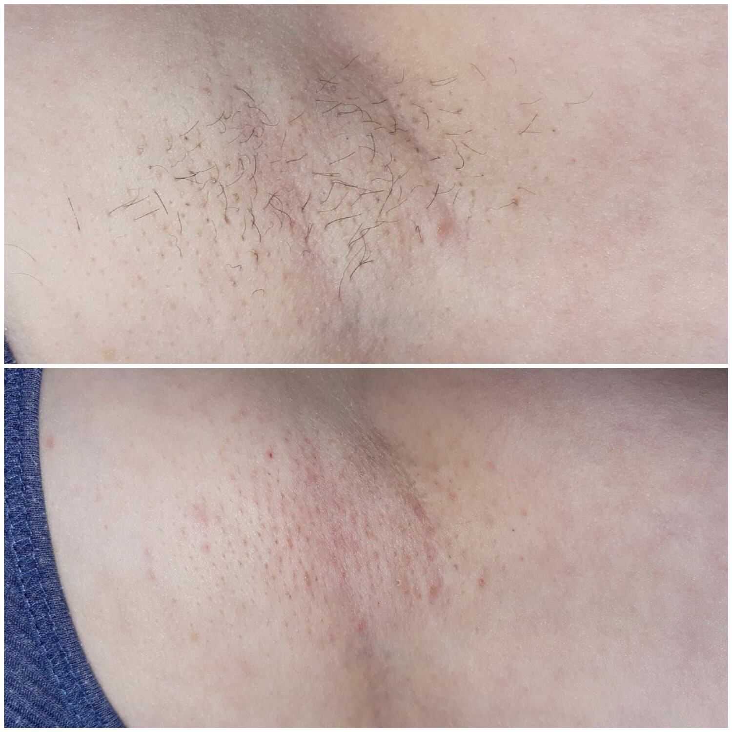 эпиляция классическое бикини, эпиляция глубокого бикини, электроэпиляция, часть тела человека, депиляция классическое бикини