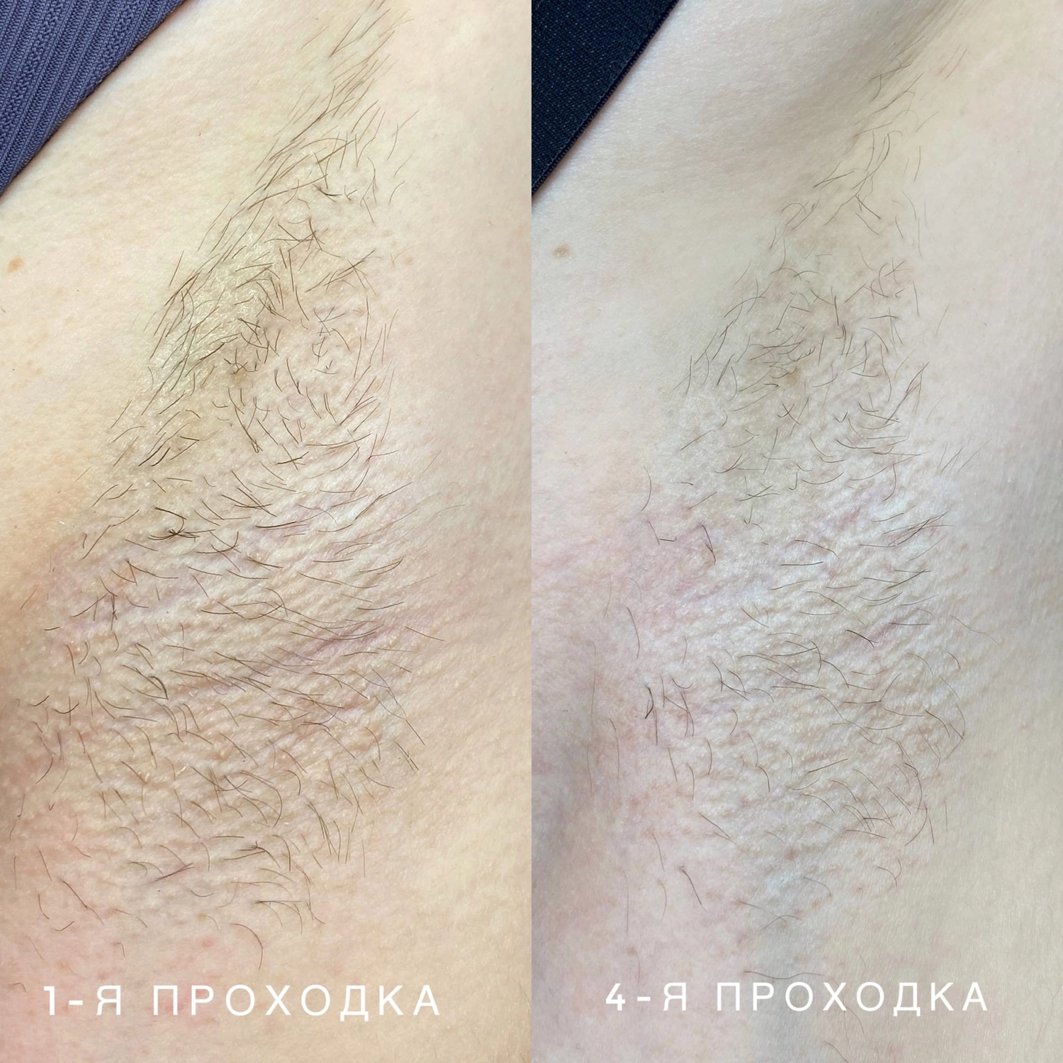 восковая депиляция, депиляция, восковая эпиляция, депиляция воском, женская депиляция