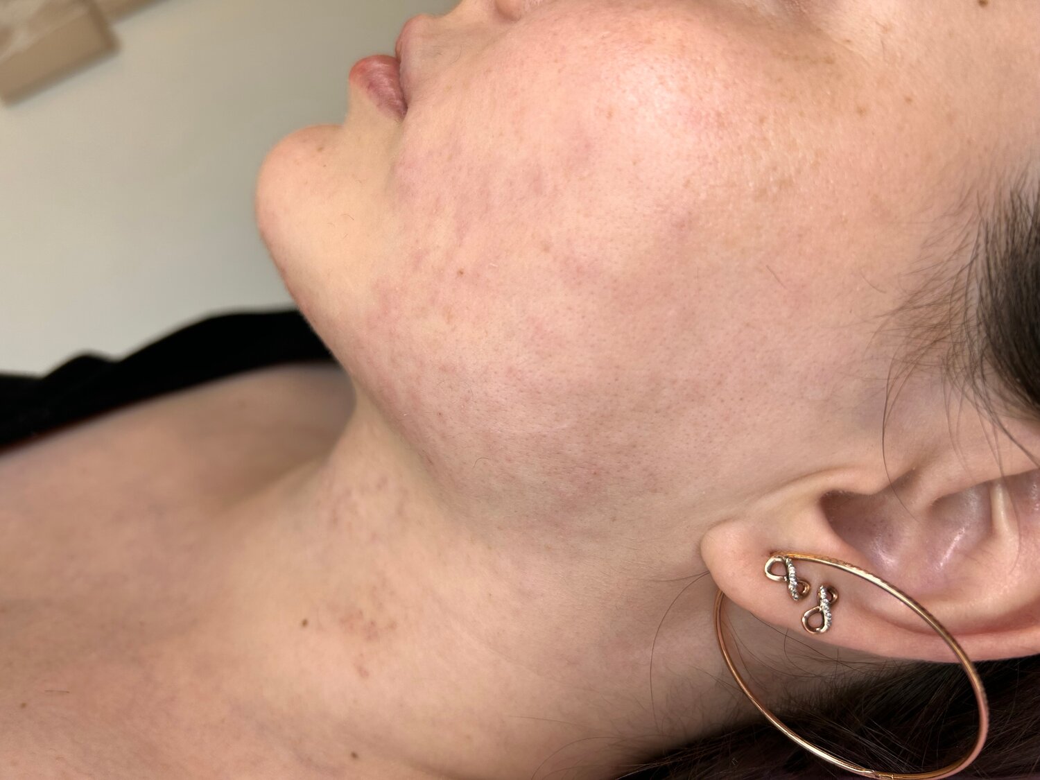 пилинг, лицо, акне, постакне, процедуры для лица