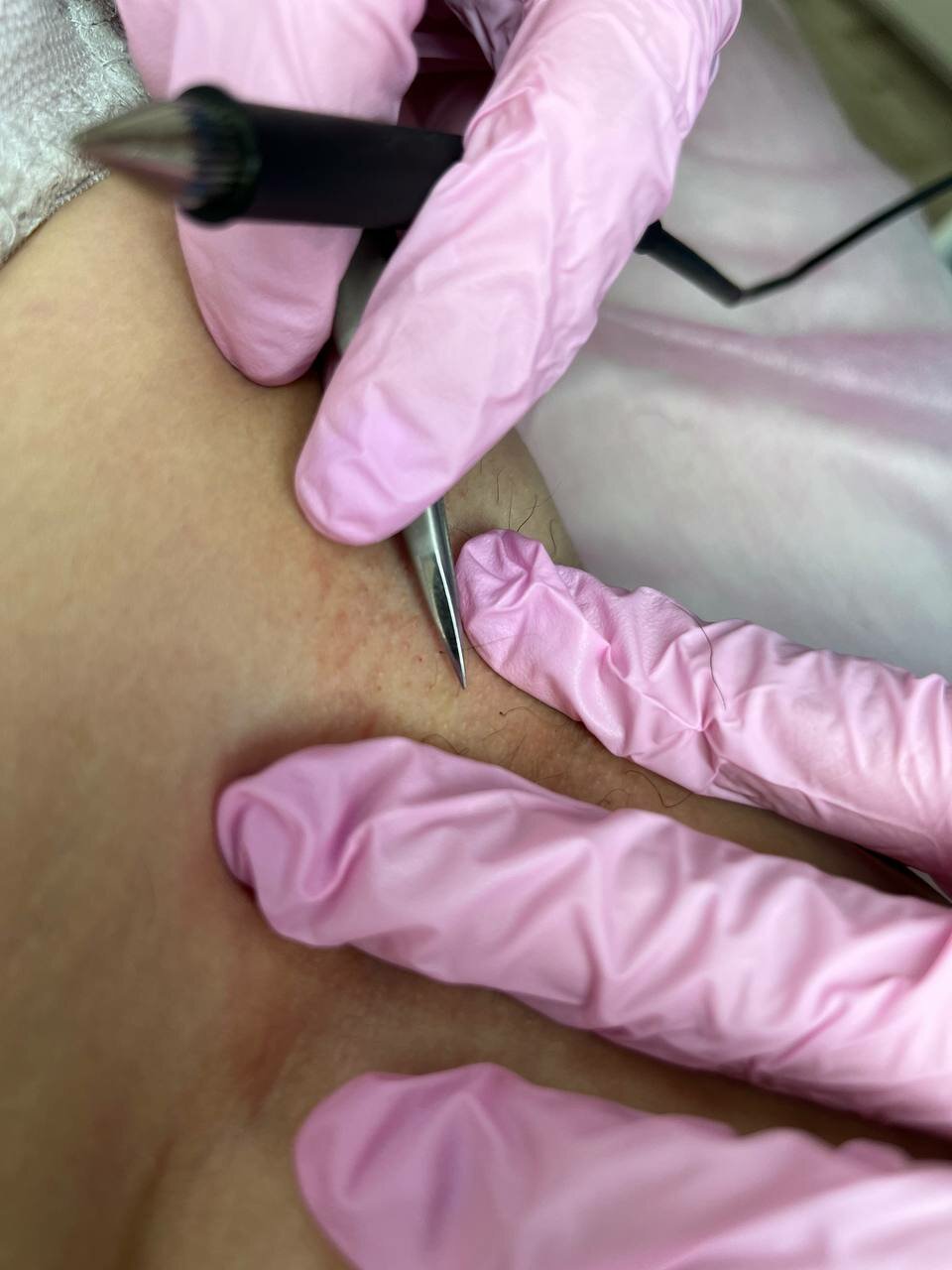 электроэпиляция, электроэпиляция зоны бикини, электроэпиляция ног, электроэпиляция в москве, электроэпиляция лица