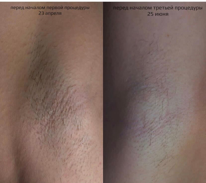 электроэпиляция, депиляция, шугаринг, эпиляция, восковая депиляция
