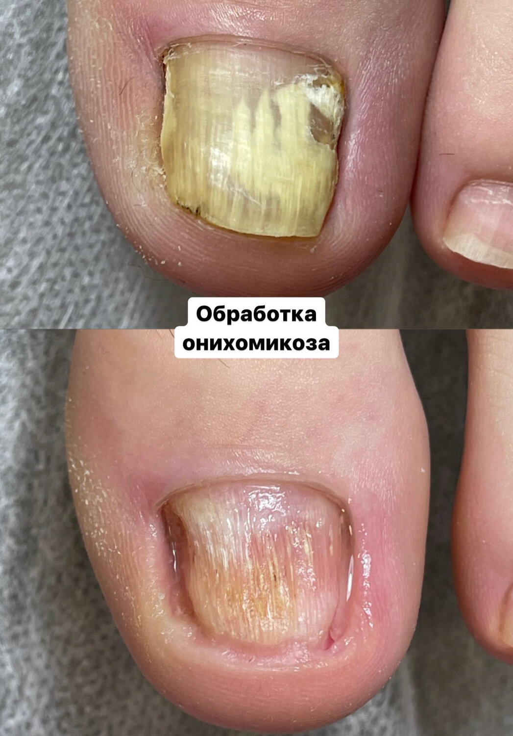 грибок на ногтях, от грибка ногтей, онихомикоз, лечение грибка ногтей, онихолизис