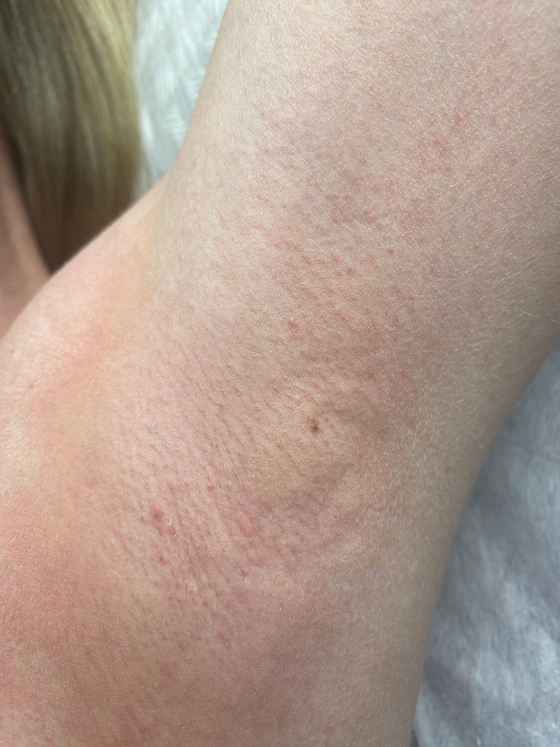 сыпь на руках, сыпь на ногах, сыпь на коже, сыпь, сыпь на коже ног