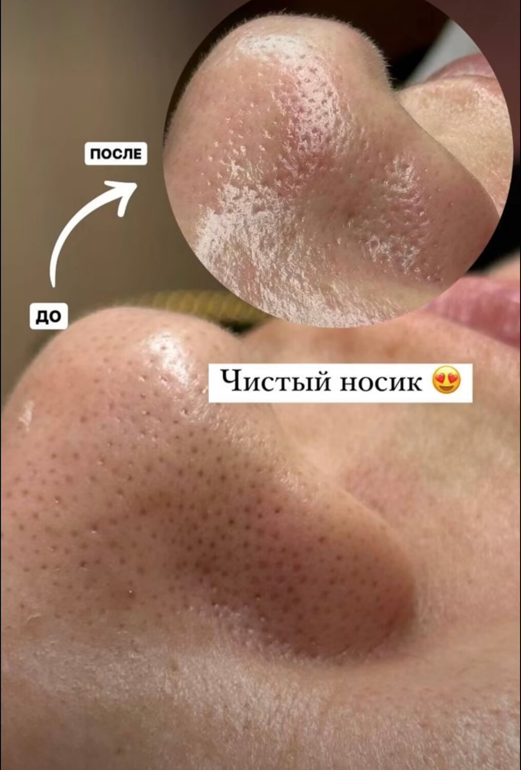 после чистки лица, чистка пор лица, чистка лица, уз чистка лица, комбинированная чистка лица