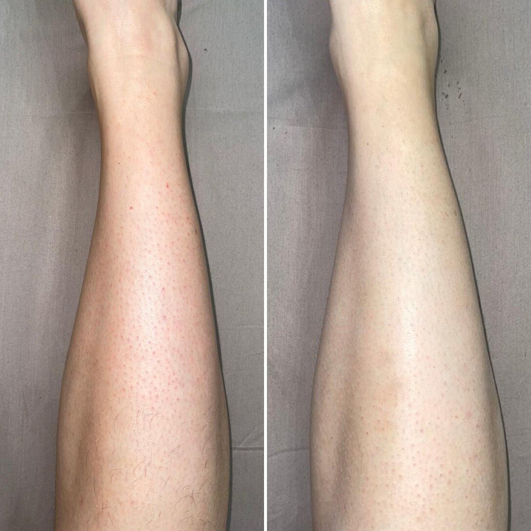 шугаринг голени, депиляция ног до и после, эпиляция, депиляция, восковая эпиляция