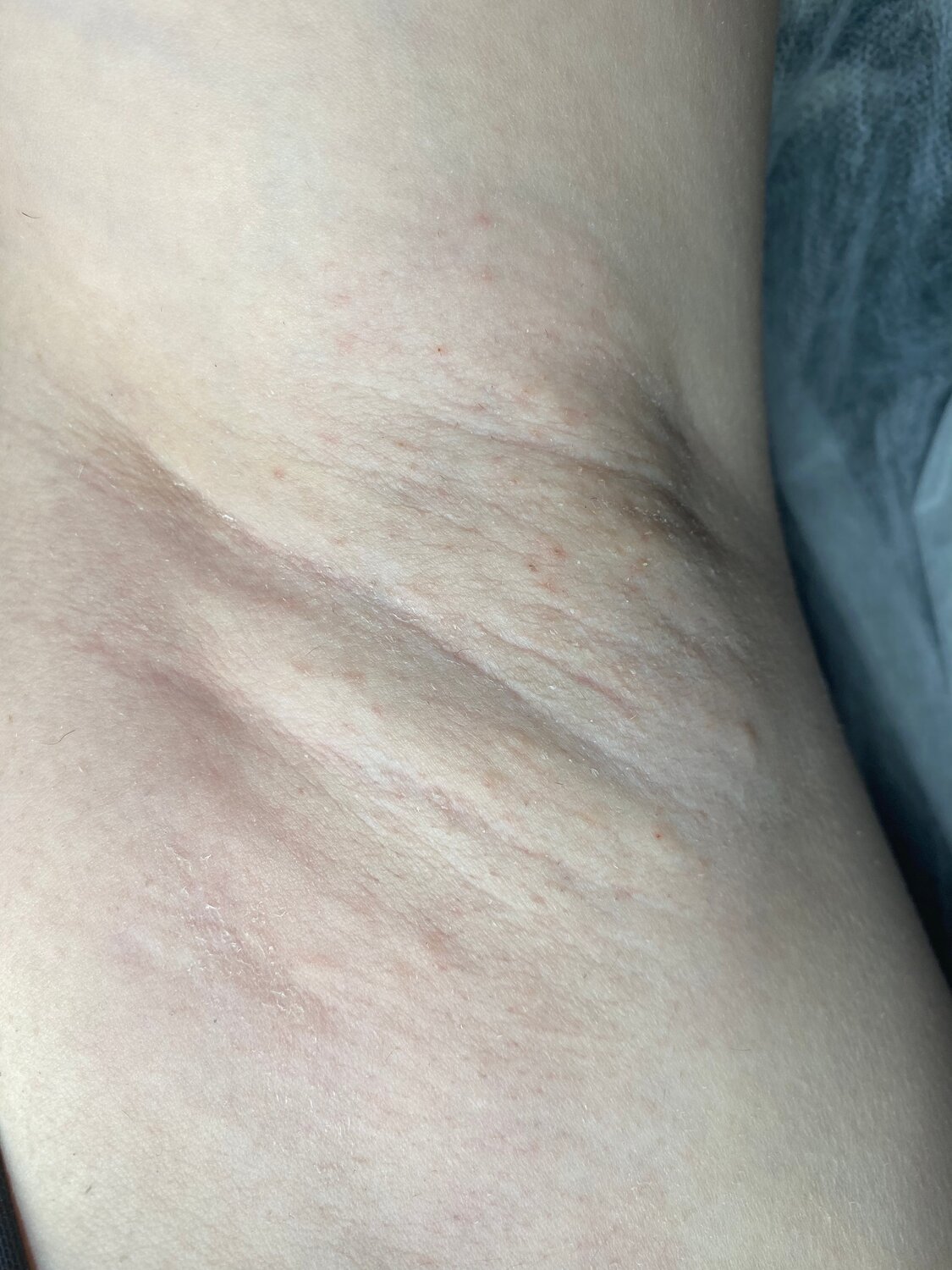 шугаринг подмышек, шугаринг глубокое, шугаринга, глубокая депиляция, депиляция подмышек